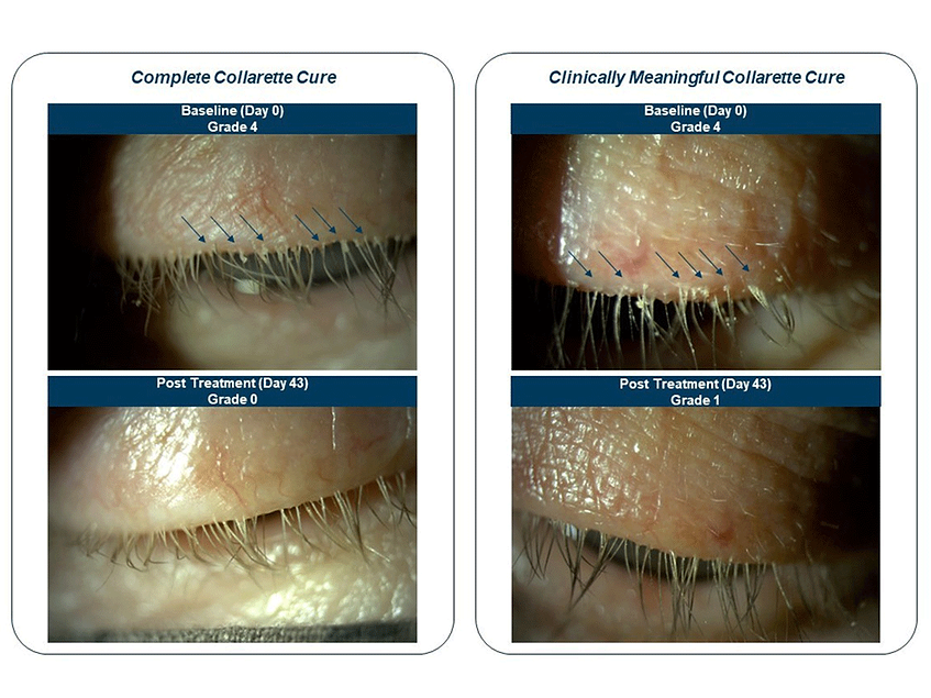 Tarsus eyes FDA filing on positive phase II/III trial in Demodex ...