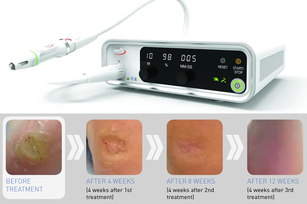Introducing Swift: The Revolutionary Device for Treating Skin Lesions ...