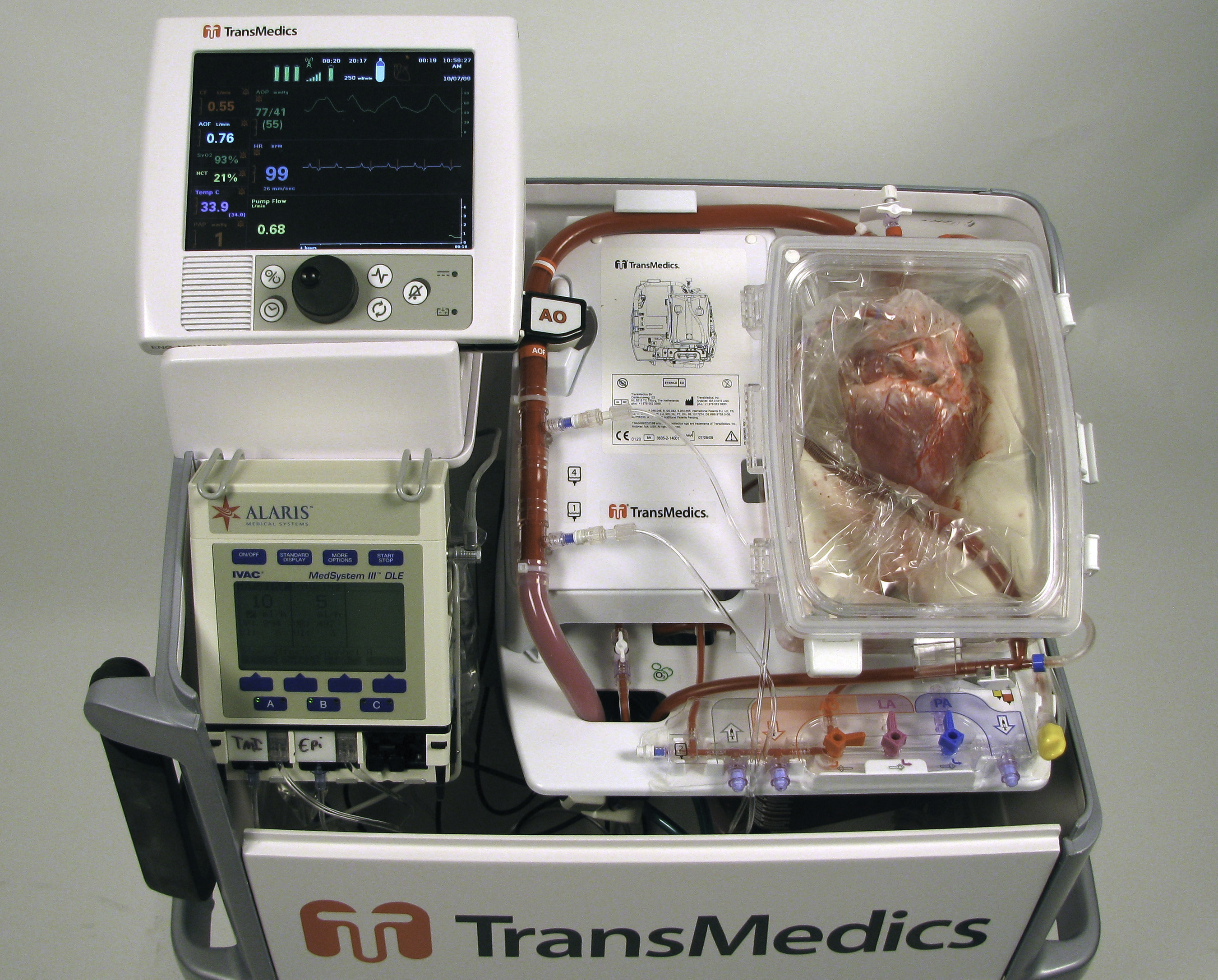 TransMedics® Organ Care System (OCS™) Used at Papworth Hospital to ...