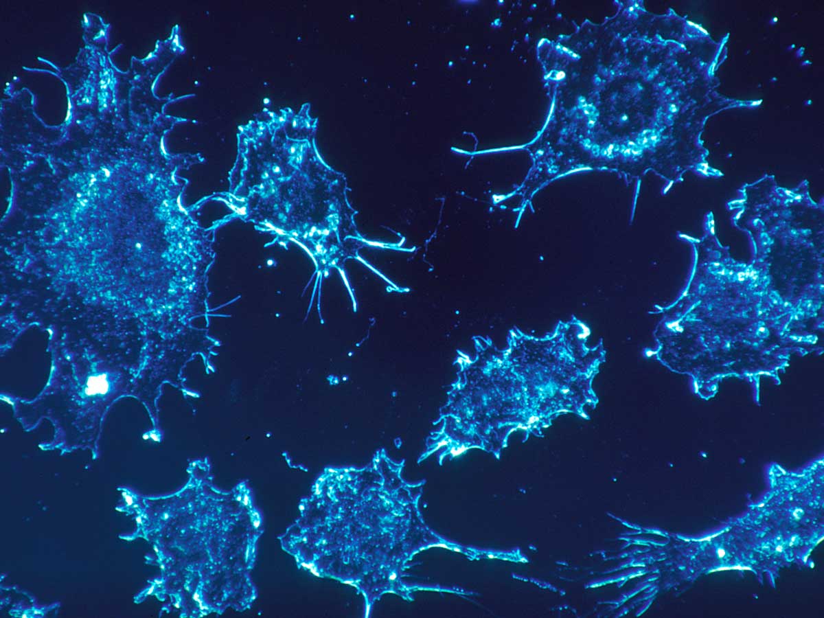ASCO 2025: Pancreatic cancer blood tests, genetic predictors of breast cancer survival and