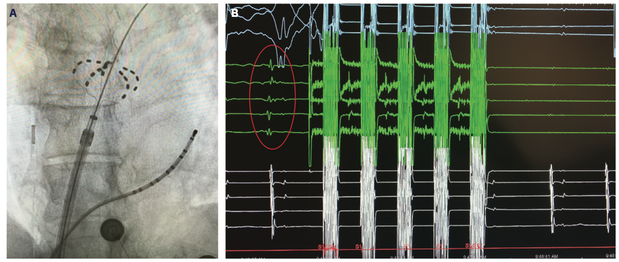 Pulsed Field Ablation for Atrial Fibrillation: Recent Advances and ...