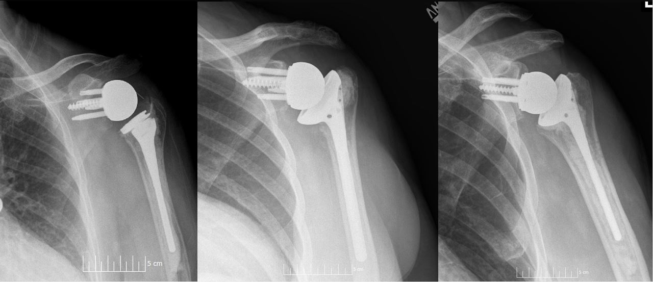 Reverse shoulder replacement - Wikipedia